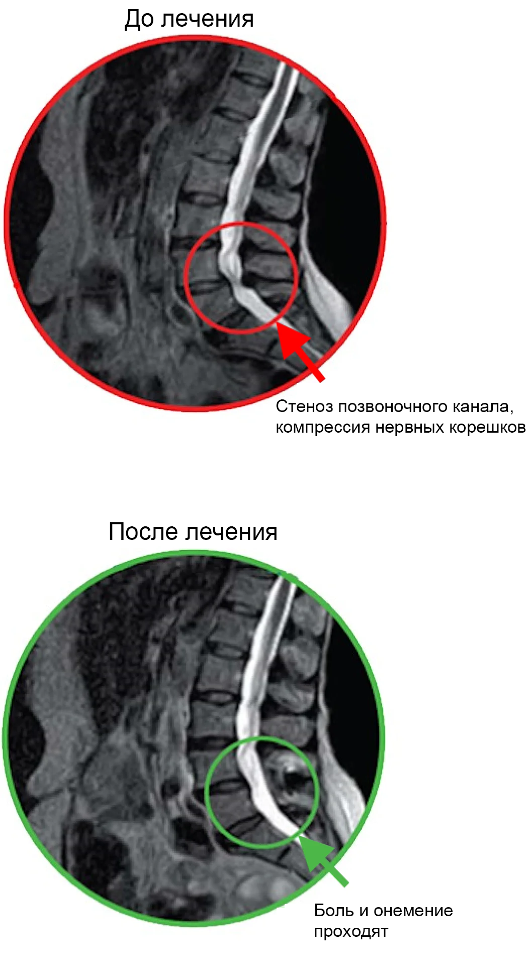 Снимки МРТ до и после лечения