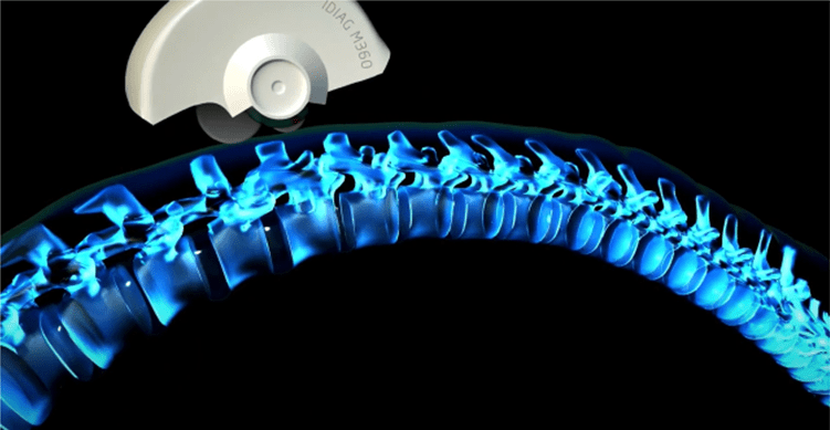 Диагностика позвоночника с помощью Spinal Mouse
